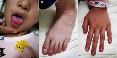 Case report: Rare abernethy malformation with hepatopulmonary syndrome in a pediatric patient